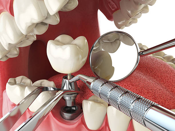 Best Emergency Treatment for Oral Infections in Fircrest, WA