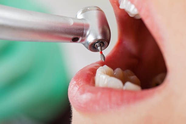 Best Dental Abscess Treatment in Fircrest, WA
